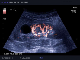 Ultrazvok ledvic - enostavna cista ledvice, barvni dopler ledvične cirkulacije